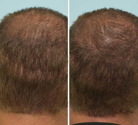 Scalp Micropigmentation for Scarring | Pittsburgh PA ...