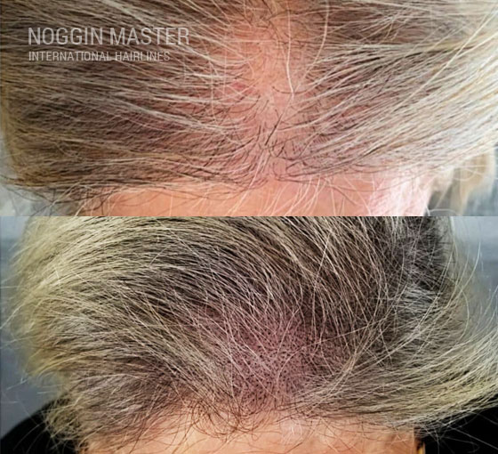 female scalp micropigmentation pittsburgh pennsylvania