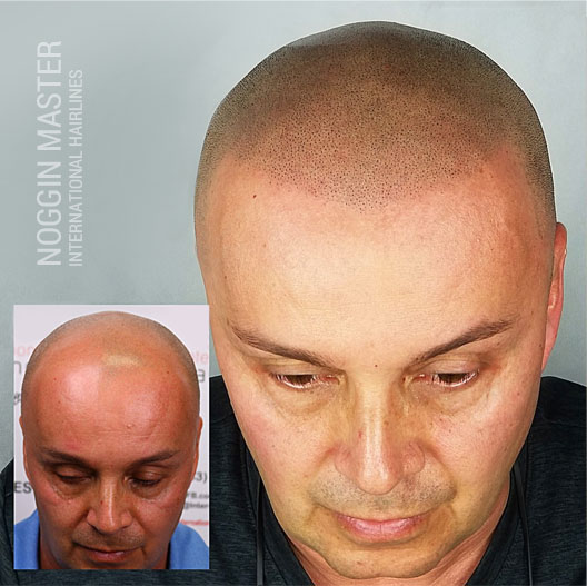 Men's SMP Scalp Micropigmentation - Pittsburgh Pennsylvania