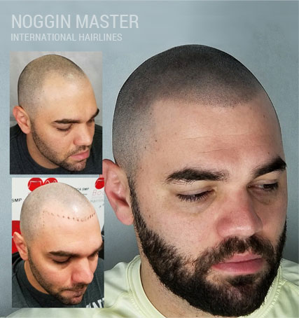 pittsburgh smp scalp micropigmentation clinic