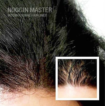 Scalp Micropigmentation SMP Women - Pittsburgh Pennsylvania